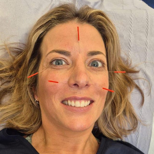 A patient receiving facial acupuncture, with fine needles placed on the forehead and cheeks